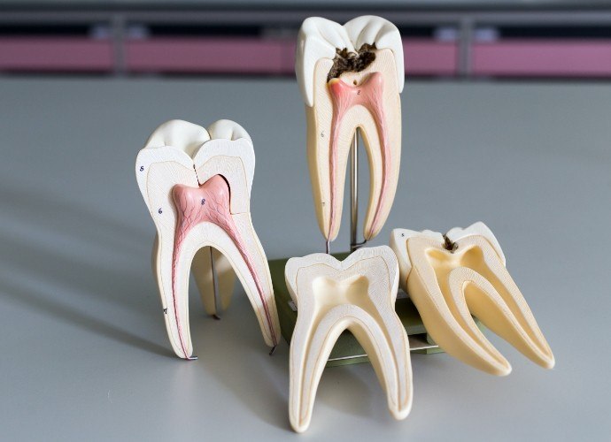 Model of inside of healthy tooth and tooth in need of root canal therapy