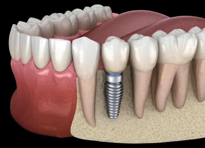 Animated smile with dental implant supported dental crown