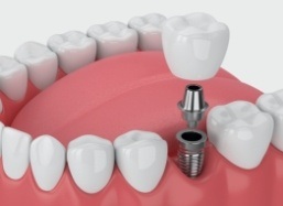 Animated dental implant supported dental crown placement