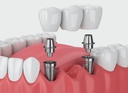 Animated dental implant supported fixed bridge placement