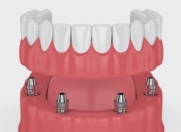 Animated dental implant supported denture placement